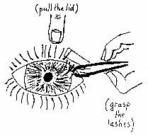 trachome_02.jpg (33547 octets)